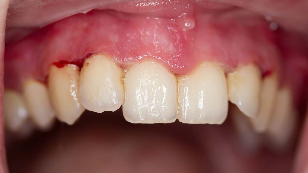 gingivitis boven casus bij tandartspraktijk godent in someren