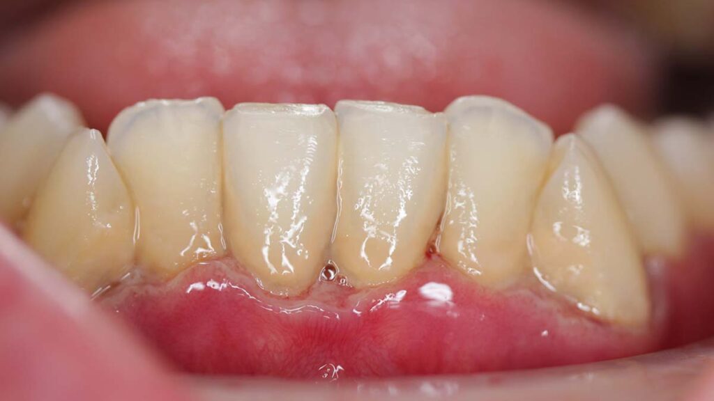 gingivitis onder casus bij tandartspraktijk godent in someren